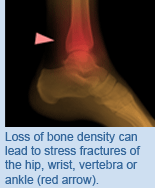 Loss of bone density can lead to stress fractures of the hip, wrist, vertebra or ankle (red arrow).