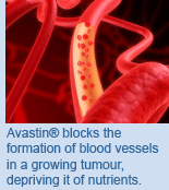 Avastin blocks the formation of blood vessels in a growing tumour, depriving it of nutrients.