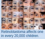 Retinoblastoma affects one in every 20,000 children.