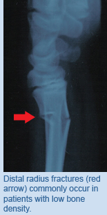 Distal radius fractures (red arrow) commonly occur in patients with low bone density.