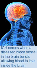 ICH occurs when a diseased blood vessel in the brain bursts, allowing blood to leak inside the brain.