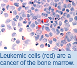 Leukemic cells (red) are a cancer of the bone marrow.