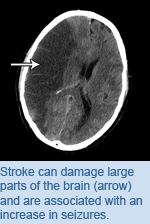 Stroke can damage large parts of the brain (arrow) and are associated with an increase in seizures.