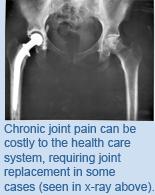 Chronic joint pain can be costly to the health care system, requiring joint replacement in some cases (seen in x-ray above).