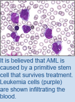 It is believed that AML is caused by a primitive stem cell that survives treatment. Leukemia cells (purple) are shown infiltrating the blood.