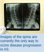 Images of the spine are currently the only way to score disease progression in AS.