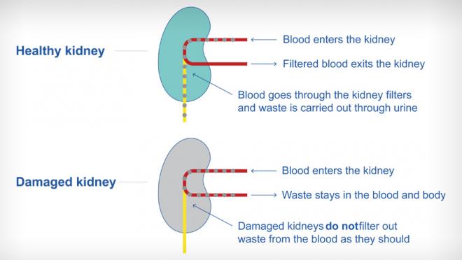 Illustration of a healthy and unhealthy kidney. Healthy kidneys filter waste and unhealthy ones do not.