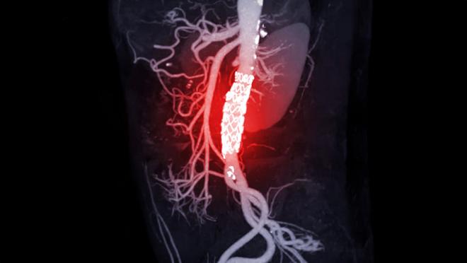 A medical image that shows the abdominal aorta with a stent. The stent is illuminated. 