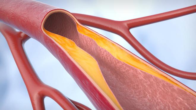Illustration of blood vessels with a build up of plaque