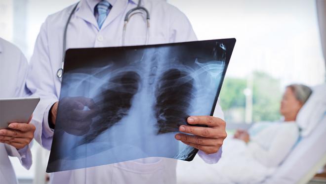 Doctor holding an x-ray of a patient's lungs with the patient in a hospital bed blurred in the background
