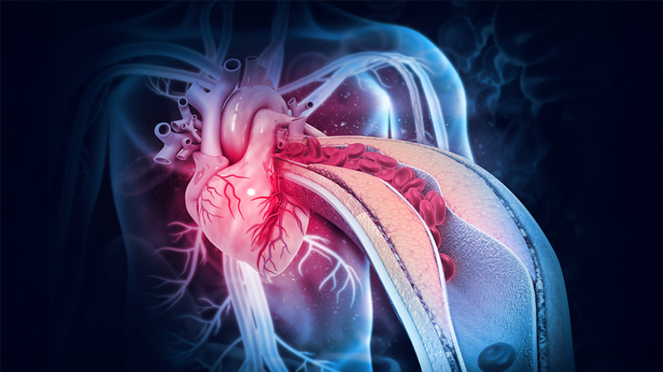 Illustration of plaques in arteries