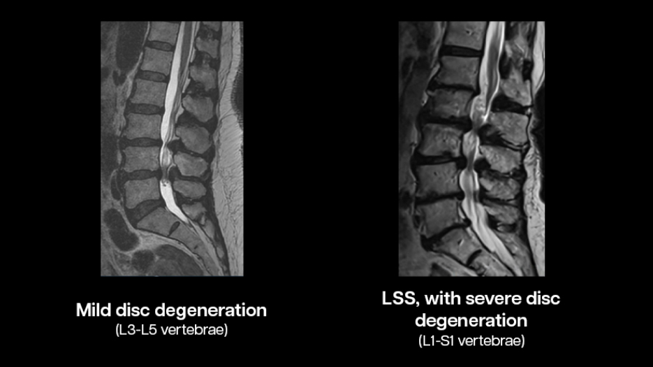 Black and white images of two spines with different levels of lumbar spine disc degeneration