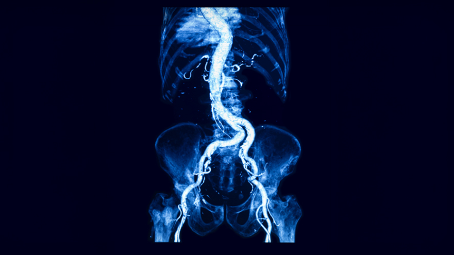 X-ray showing aorta running through the abdomen.