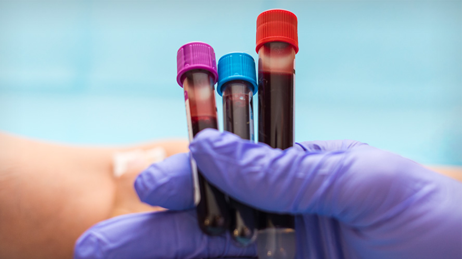 A hand holding a few vials of blood for a blood test.