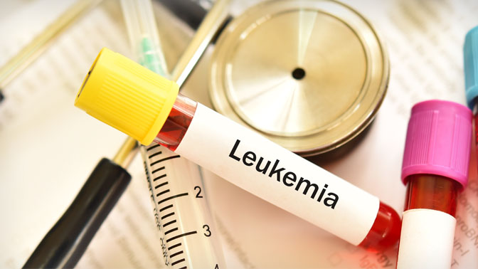 The five-year survival rate of acute myeloid leukemia is 21% in Canada, with approximately 1,000 new cases diagnosed each year.