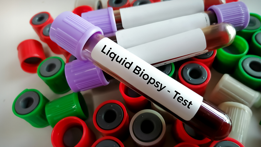 Circulating tumour DNA (ctDNA) can be analyzed using blood tests as part of a liquid biopsy. Liquid biopsies are blood tests used to detect cancer cells or other markers of disease.