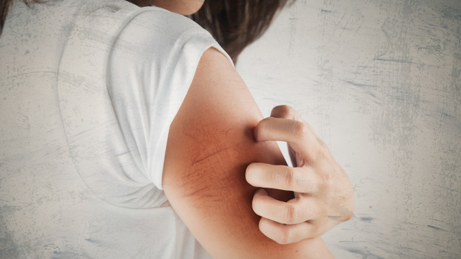 Fibrosis is often a late side effect of radiotherapy for cancer and can occur years after the original treatment. Skin fibrosis leads to thickening of the skin (similar to what happens when a scar forms after an injury) and can cause pain, severe itching 