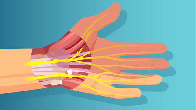 Many steps are involved in hand transplant surgery, including the attachment of bones, nerves, arteries, veins and tendons.