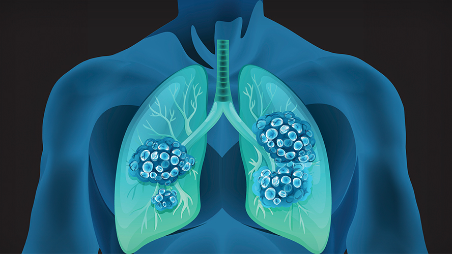 Graphic of lungs showing cancer spread.