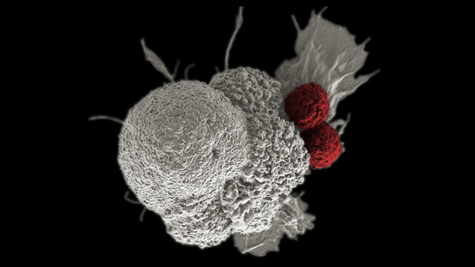 A pseudo-colored scanning electron micrograph of an oral squamous cancer cell (white) being attacked by two cytotoxic T cells (red), part of a natural immune response.
