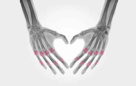 Inflammatory conditions like psoriatic arthritis increase patients' likelihood of having a cardiovascular event such as an irregular heartbeat, high blood pressure and heart failure.