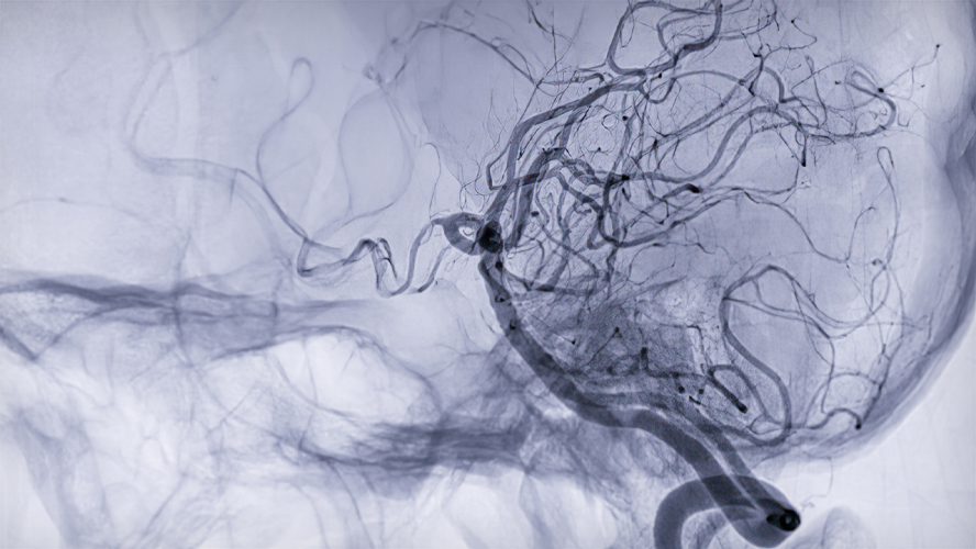 Black and white image showing blood vessels in the brain