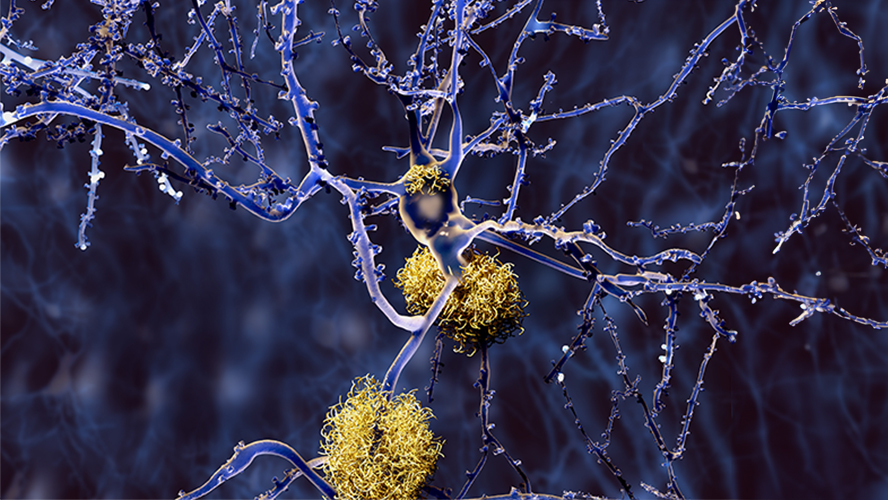 In Alzheimer disease, misfolded amyloid beta protein accumulates as plaques in the brain and interrupts neuron function. Lecanemab targets toxic forms of the protein and promotes its clearance by the immune system.
