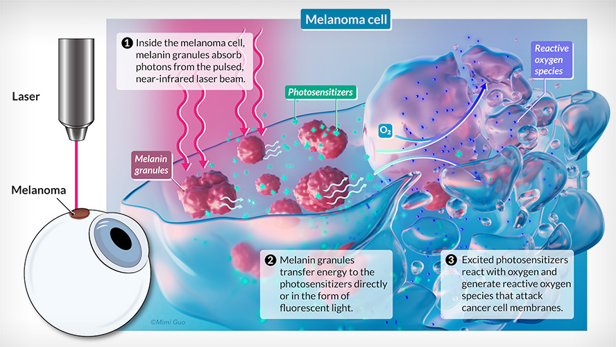 Illustration of treatment method.