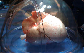 During ex vivo lung perfusion, the lungs' blood vessels are flushed with a solution containing complex sugars, an antibiotic and a medication to block inflammation.